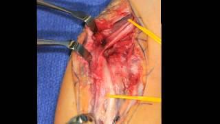 Split Median Nerve Graft -Case Report, Scott Kozin, MD and Dan Zlotolow, MD