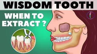 Wisdom Teeth Removal / When to extract Wisdom teeth (Third molar) / Animation // Medinaz