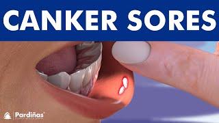 CANKER SORE - Treatment and mouth ulcer causes ©