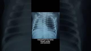 Newborn X-ray l Interesting X-ray series-pause, review and comment #nicu