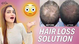 Hair Loss Solution || Best Solution For Hair Loss By Dr Javeria Jia || Dermatologist