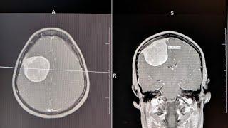 Brain Tumor Symptoms Described