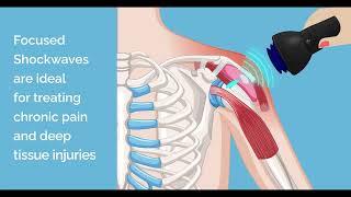 Focused Vs Radial Shockwave Therapy: What's The Difference?