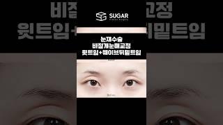 눈재수술전후노필터사진공개!#비절개눈매교정 #윗트임#뒤밑트임  #슈가성형외과