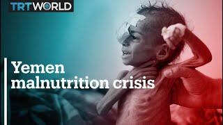 Millions of Yemeni children suffer from malnutrition