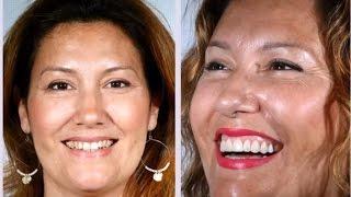 CARILLAS SIN TALLAR LOS DIENTES PARA UNA SONRISA PERFECTA