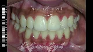 Braces /Aligners Treatment