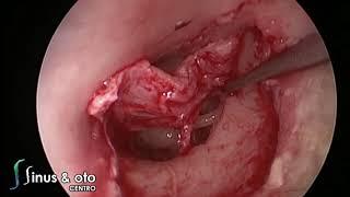 Endoscopic Tympanoplasty - Full