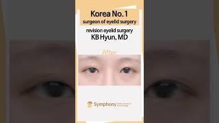 Korean eyelid revision surgery before and after pictures, Korean No.1 surgeon's techique!! #shorts