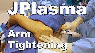 Renuvion (JPlasma) - Subdermal Arm Tightening - Dr. Paul Ruff | West End Plastic Surgery