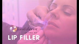 Juvederm Ultra Lip Filler | Total Dermatology