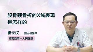 股骨颈骨折的X线表现是怎样的 崔长权 灌南县第一人民医院