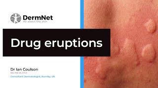 Understanding Drug Eruptions