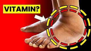 #1 Vitamin to Eliminate Swelling in Feet and Legs | HealthQuest