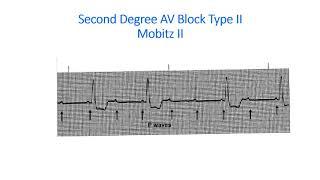 AV BLOCKS 2020