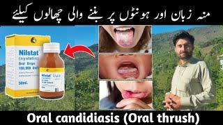 nilstat drop uses | moun ke chalon ka elaj | mouth ulcer treatment | oral ulcer treatment | nilstat