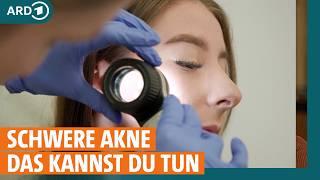 Akne – Was hilft bei Pickeln, Pusteln und Mitessern? I ARD Gesund | Re-Upload