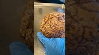 Seizures and the Brain