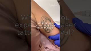 Laser Tattoo Removal with a PFD patch for maximized results #lasertreatment