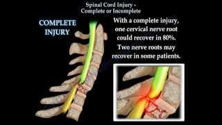 Spinal Cord Injury Complete Or Incomplete - Everything You Need To Know - Dr. Nabil Ebraheim