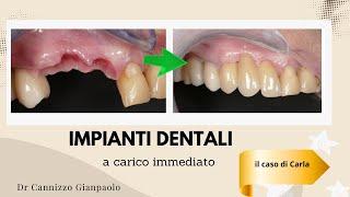 Caso di impianto di denti fissi eseguito in un'ora - Studio Cannizzo Milano