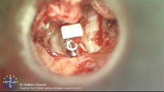 Ossiculoplasty with TORP Malleus relocation & Silastic Banding Dr Robert Vincent