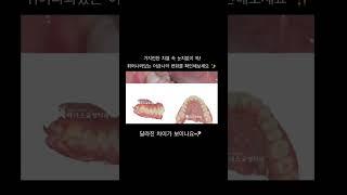 가지런한 치열 속 옥에티를 찾아보세요  #덧니 #교정치료과정 #치아교정 #교정치과