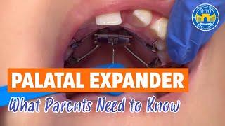 8 Things to Know About Palatal Expander