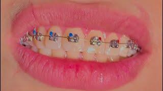 How braces are put on #dental #dentistry #smile #umairtoothfairy @Umairazeem8553