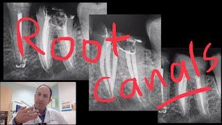 Root Canals and Retreats of Root Canals #18