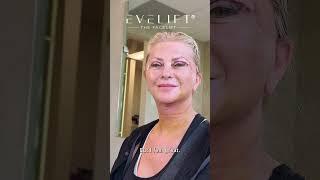 Sonja's EVE Lift™ Journey | Eden Plastic Surgery: Dr. Ali Charafeddine, MD