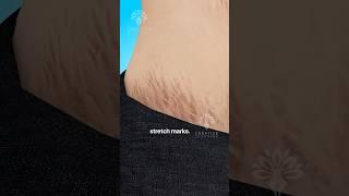 Why Do Stretch Marks Really Happen  #shorts #viralvideo - Creativelearning3d