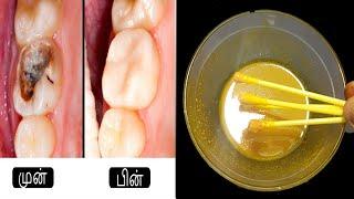 1 சொட்டு சொத்தைப் பல்லில் வையுங்க பல்லை புடுங்க வேண்டாம் | teeth pain home remedy in tamil