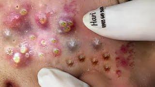 Big Cystic Acne Blackheads Extraction Blackheads & Milia, Whiteheads Removal Pimple Popping # 1240