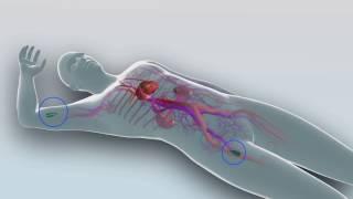 Nexus Endovascular Repair for the Aortic Arch