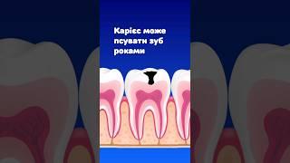 Краще не затягуйте лікування, бо ви карієс може розвинутись #карієс #пломба #стоматолог