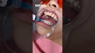 Операция по раскрытию ретинированного клыка  #стоматология #брекеты #braces