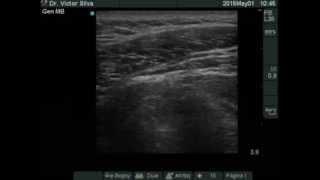 Trigger point injection - Ultrasound guided