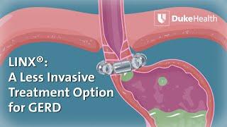 Using LINX® to Treat GERD  | Duke Health