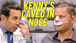 Kenny's Rhinoplasty Gone Wrong: Nose COLLAPSES After Botched Nose Job | Botched | E!