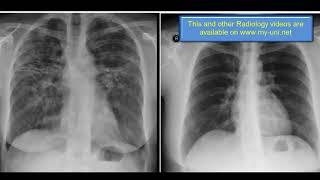 Chest Xray : ILD Fibrosis, Traction bronchiectasis, Sarcoidosis ( by hammadshams)