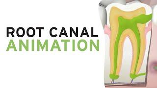 Root Canal Treatment RCT (Step by Step Animation)