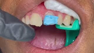 Houston Cosmetic Dentist...I hate my front tooth gap! Step by Step bonding procedure in one hour!