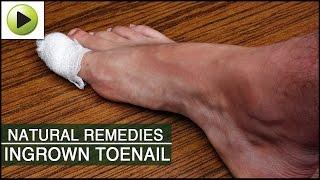 Natural Remedies for Ingrown Toenail