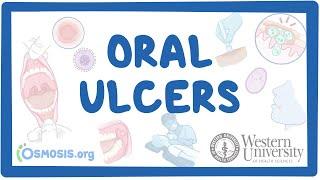 Western University - Oral Ulcers