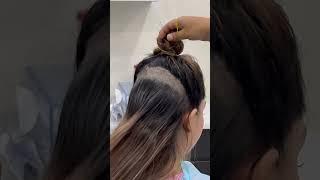 Female hair transplant | Dadu Medical Centre | Dr. Nandni Daddu