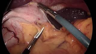 Laparoscopic Sleeve Gastrectomy: Surgical Technique