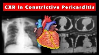 Chest X ray in Constrictive Pericarditis (Part 7)