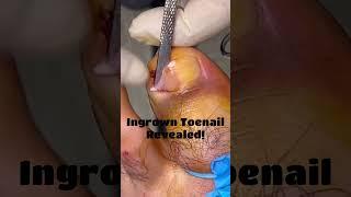 What An Ingrown Toenail Really Looks Like