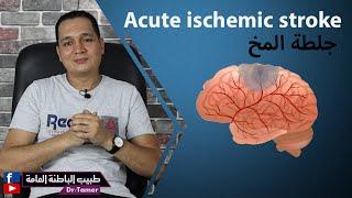 جلطة المخ / Acute ischemic stroke